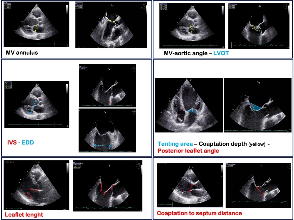 Image_1_Two and Three-Dimensional Echocardiography in Primary Mitral Regurgitation_ Practical Hints to Optimize the Surgical Planning.jpg
