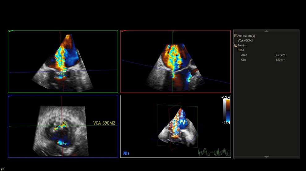 Image_2_Two and Three-Dimensional Echocardiography in Primary Mitral Regurgitation_ Practical Hints to Optimize the Surgical Planning.jpg