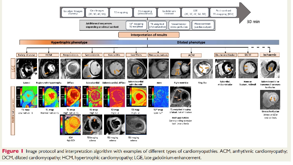 MRI cardiomyopathy.jpg
